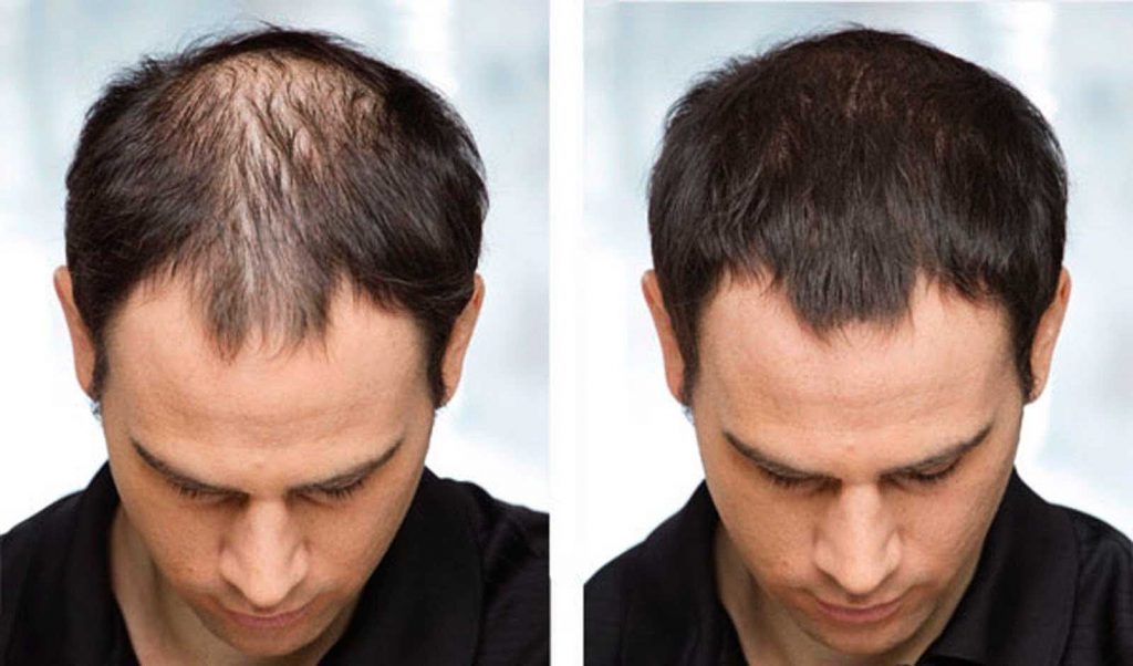 Hair Loss Treatments: How Effective are They? - A DIY Projects