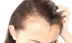 Why you Should Deal with Thinning Hair Early