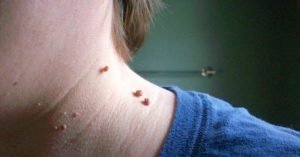 Are Skin Tags Harmful? And How To Get Rid of Them?