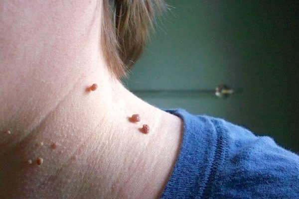 Are Skin Tags Harmful? And How To Get Rid of Them?